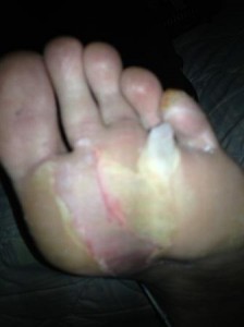 Poorly Feet 2012